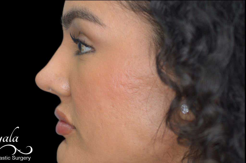Rhinoplasty Case 46 – After