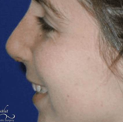 Rhinoplasty Case 5 – After