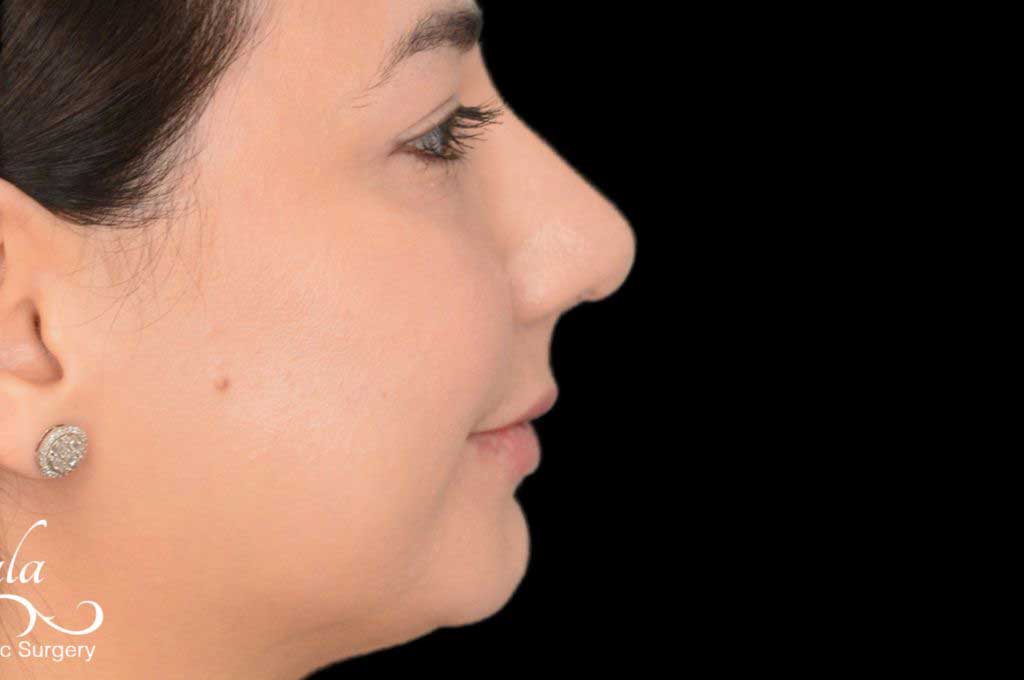 Rhinoplasty Case 47 – After