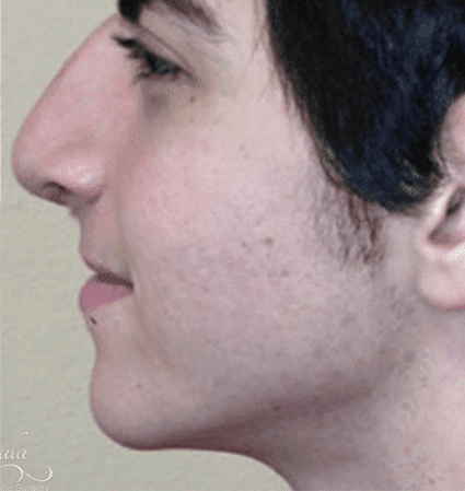 Rhinoplasty Case 6 – After