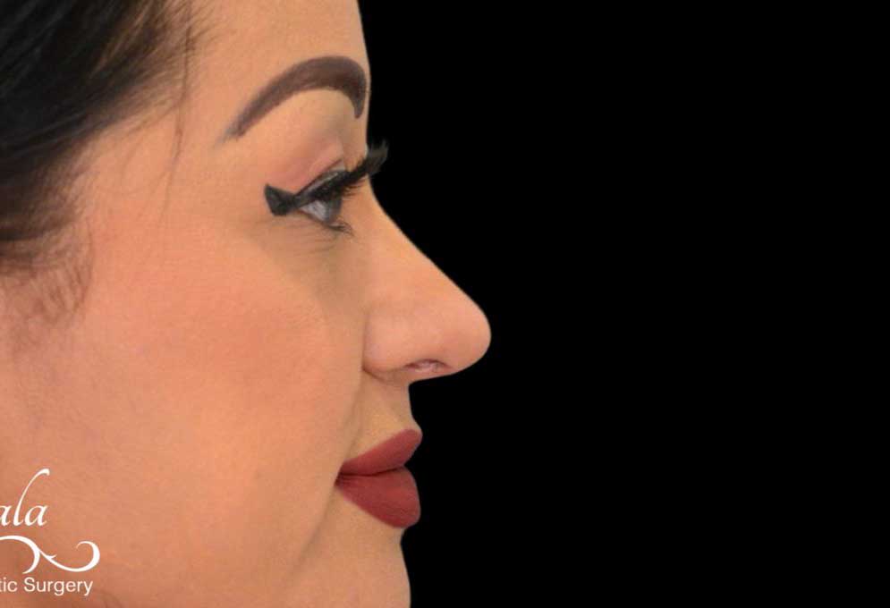 Rhinoplasty Case 49 – After