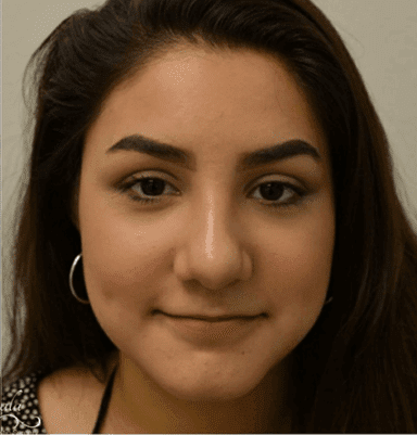 Rhinoplasty Case 8 – After