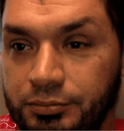 Rhinoplasty Case 9 – After