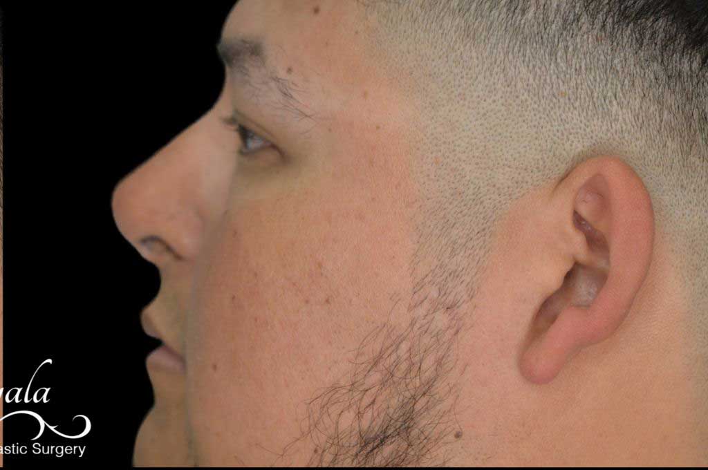Rhinoplasty Case 51 – After