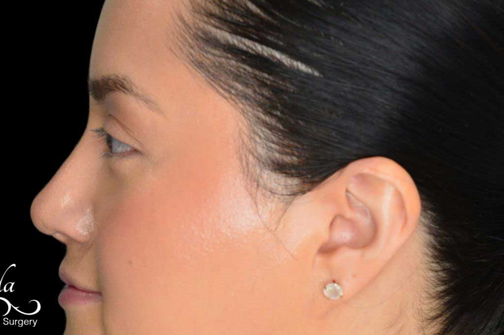 Rhinoplasty Case 52 – After