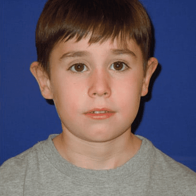 Ear Surgery Case 2 – After