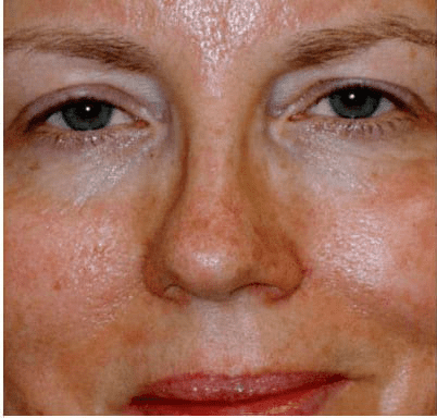 Eyelid Surgery Case 1 – After