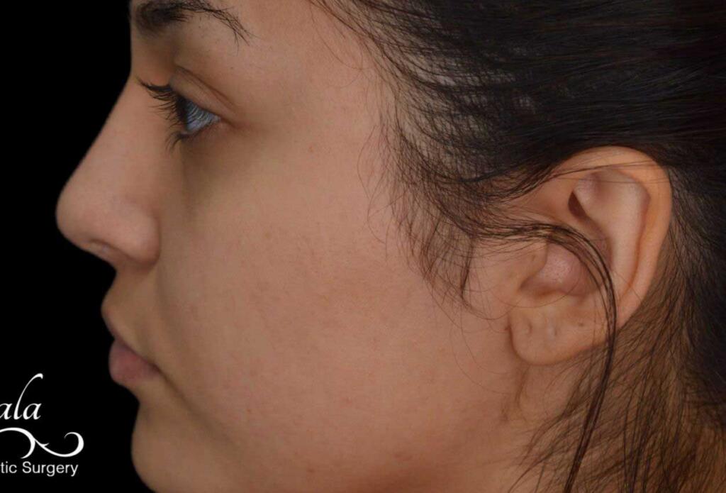 Rhinoplasty Case 55 – After