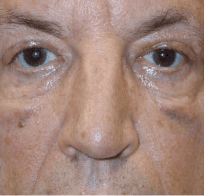 Eyelid Surgery Case 2 – After
