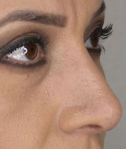 Rhinoplasty Case 28 – After