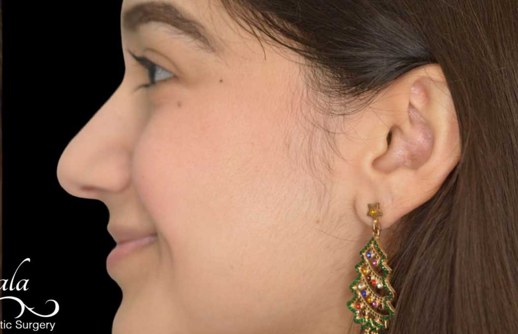 Rhinoplasty Case 56 – After