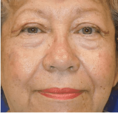 Eyelid Surgery Case 3 – After