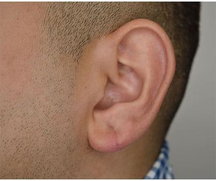 Ear Surgery Case 4 – After