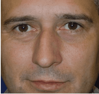 Eyelid Surgery Case 4 – After