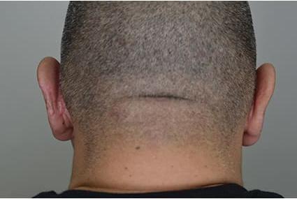 Ear Surgery Case 6 – After