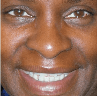 Lip Augmentation Case 2 – After