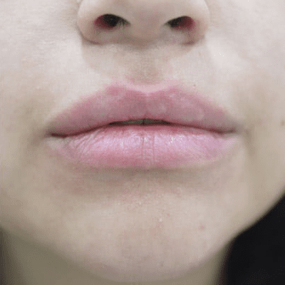 Lip Augmentation Case 3 – After