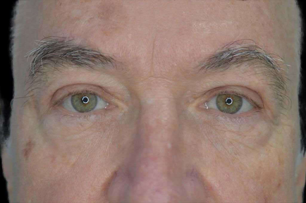 Eyelid Surgery Case 6 – After