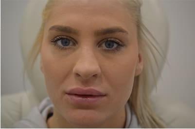 Lip Augmentation Case 4 – After