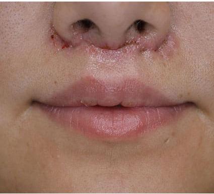 Lip Augmentation Case 5 – After