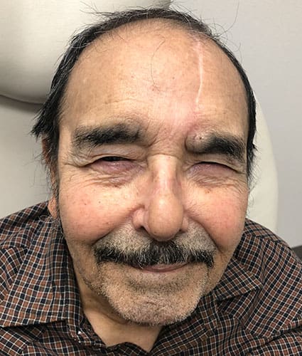 Rhinoplasty Case 29 – After
