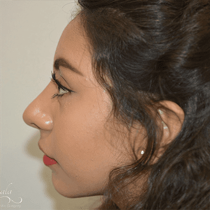 Rhinoplasty Case 13 – After