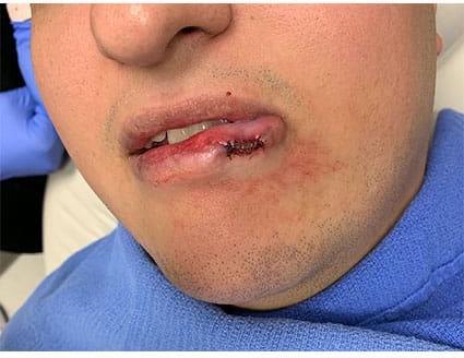 Lip Augmentation Case 6 – After