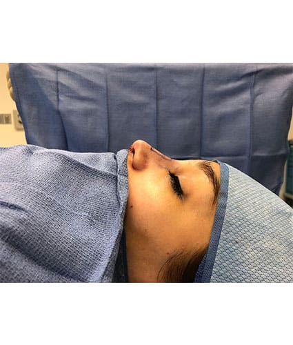 Rhinoplasty Case 30 – After