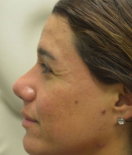 Rhinoplasty Case 31 – After