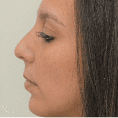 Rhinoplasty Case 15 – After