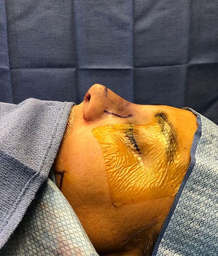 Rhinoplasty Case 32 – After
