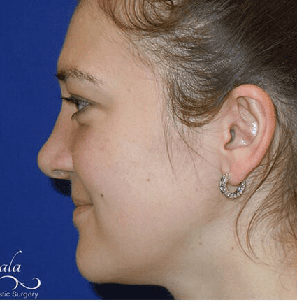 Rhinoplasty Case 16 – After