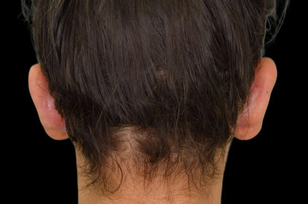 Ear Surgery Case 17 – After