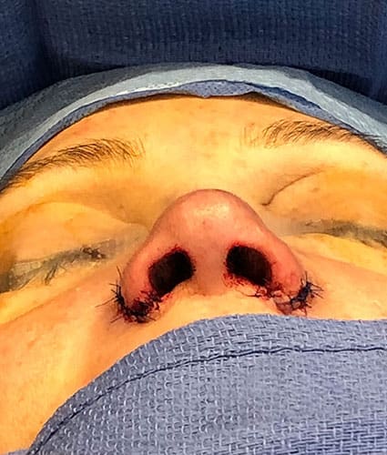 Rhinoplasty Case 33 – After