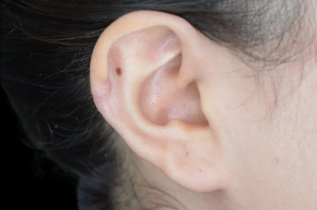 Ear Surgery Case 8 – After