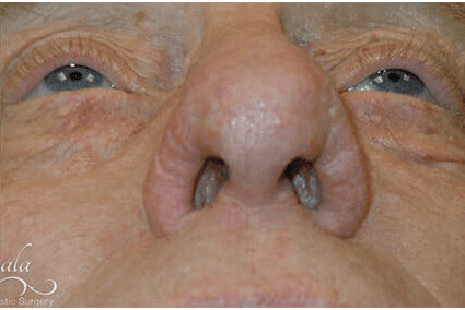 Rhinoplasty Case 18 – After