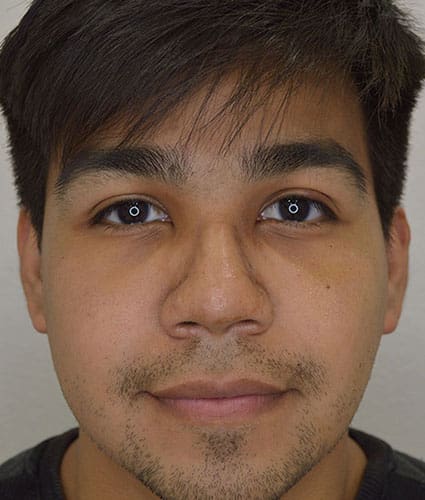 Rhinoplasty Case 25 – After