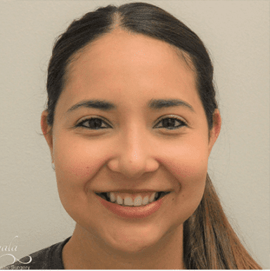 Rhinoplasty Case 1 – After