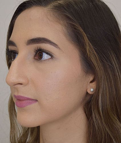 Rhinoplasty Case 26 – Before