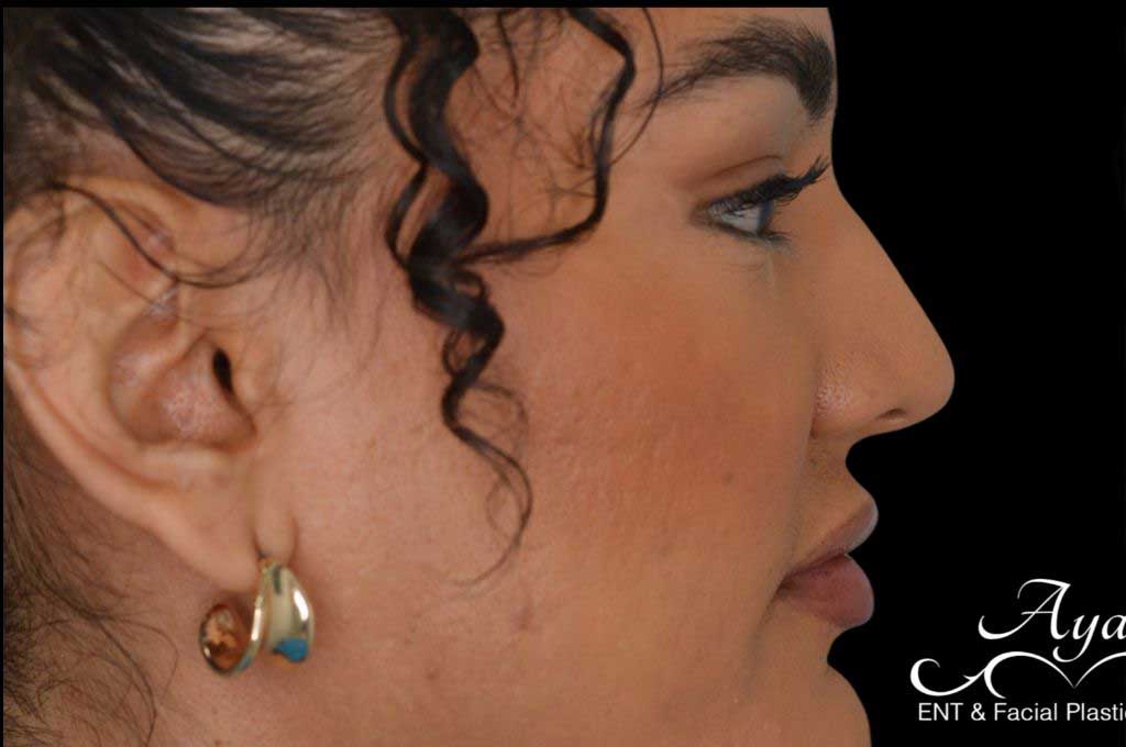 Rhinoplasty Case 46 – Before