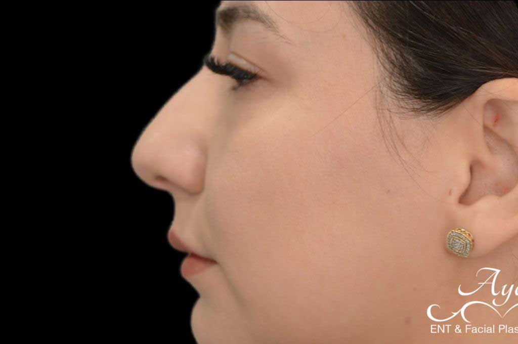 Rhinoplasty Case 47 – Before