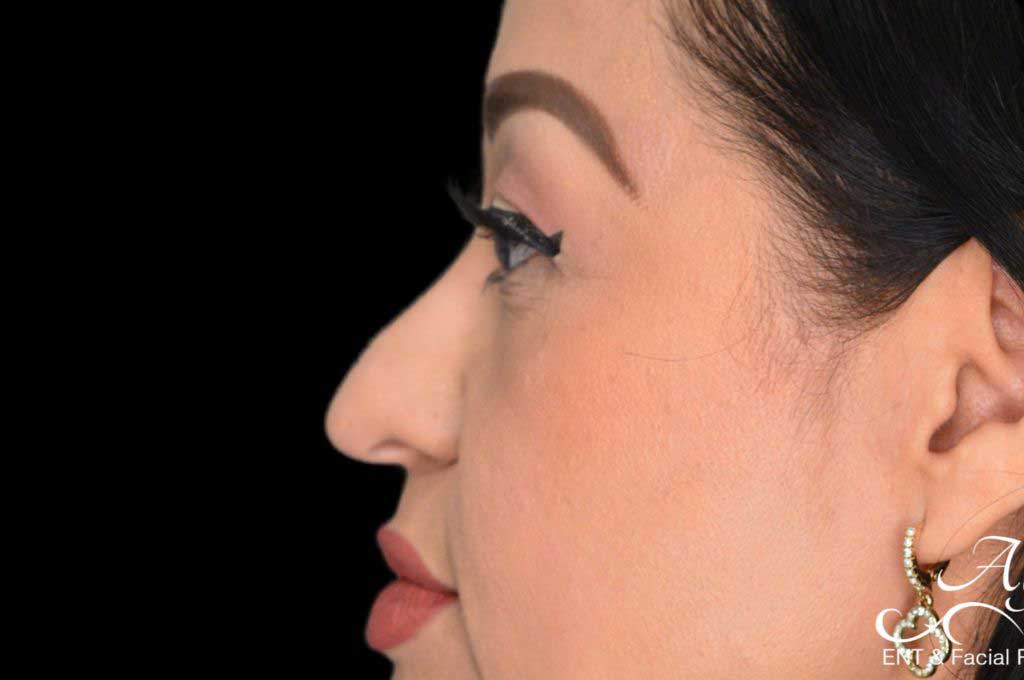 Rhinoplasty Case 49 – Before