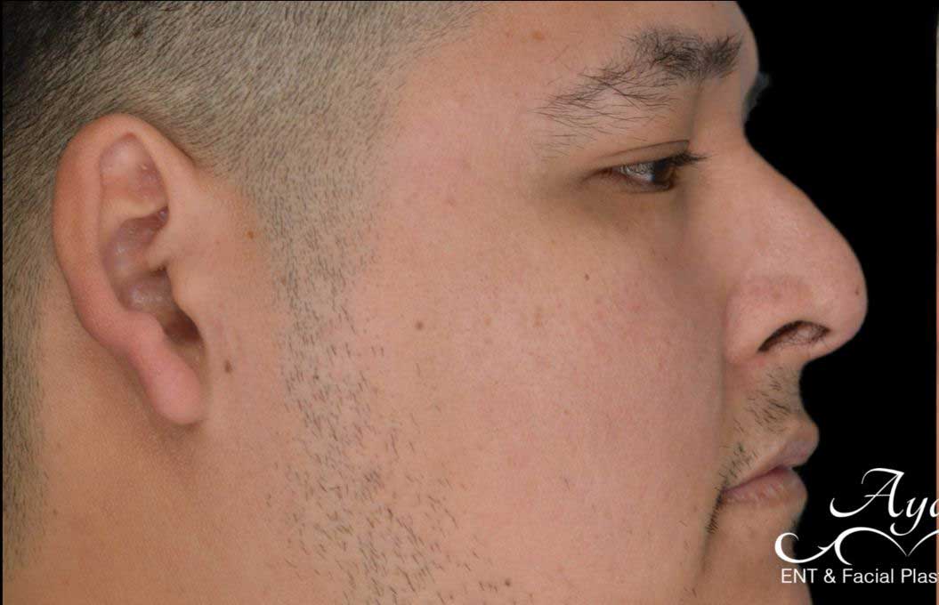 Rhinoplasty Case 51 – Before