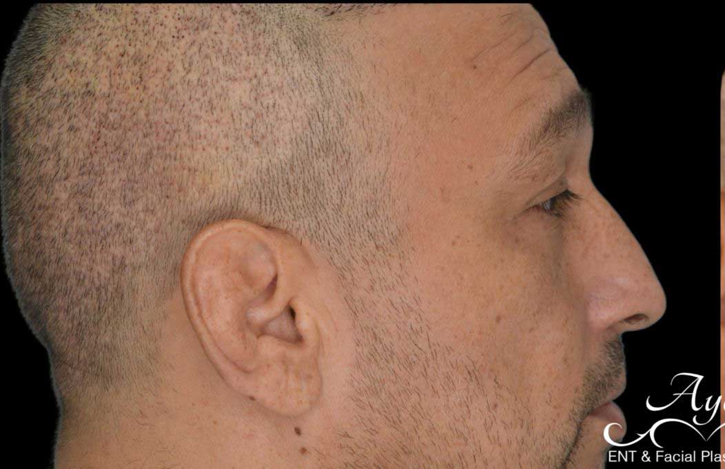 Rhinoplasty Case 53 – Before