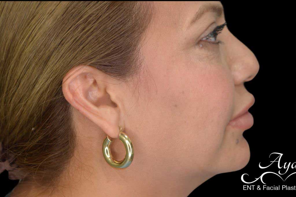 Rhinoplasty Case 54 – Before
