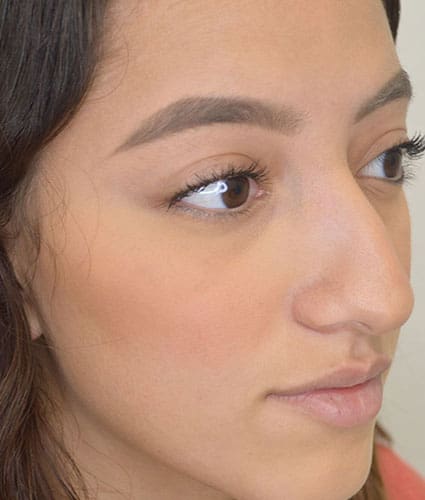 Rhinoplasty Case 27 – Before