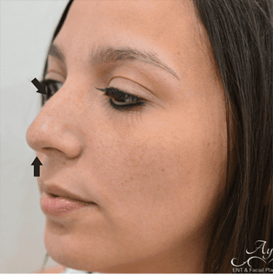 Rhinoplasty Case 15 – Before