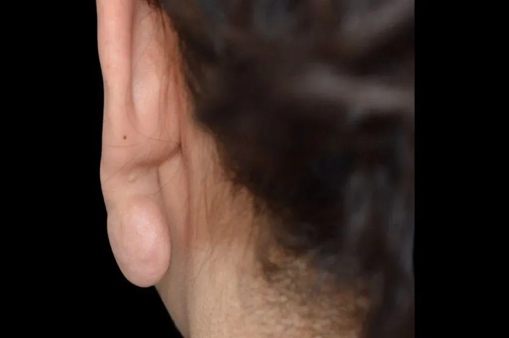 Ear Surgery Case 12 – Before