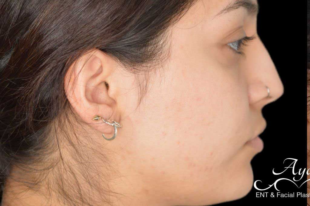 Rhinoplasty Case 55 – Before