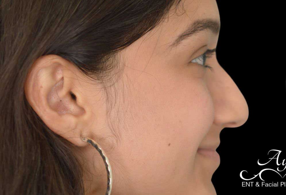 Rhinoplasty Case 56 – Before